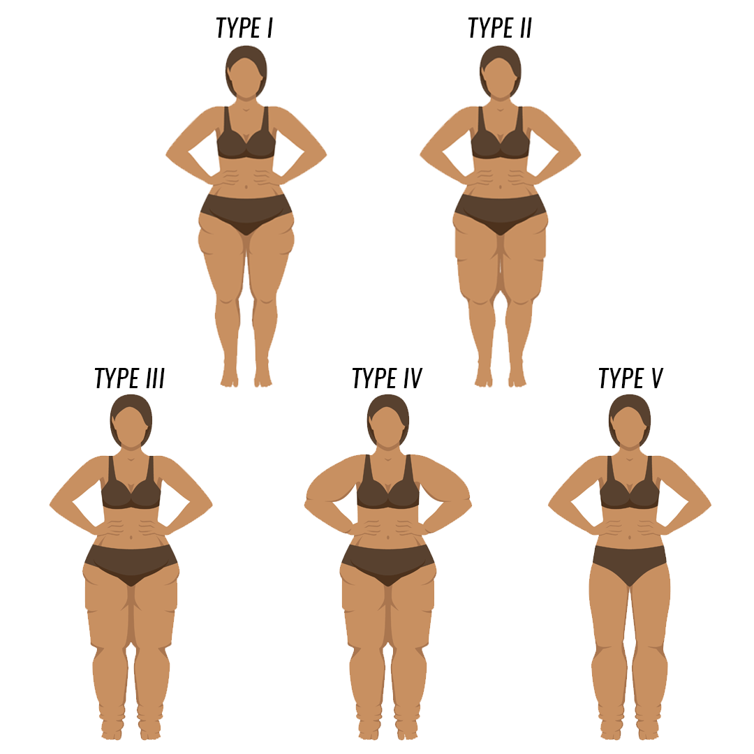 LIPEDEMA-TYPES-CHART